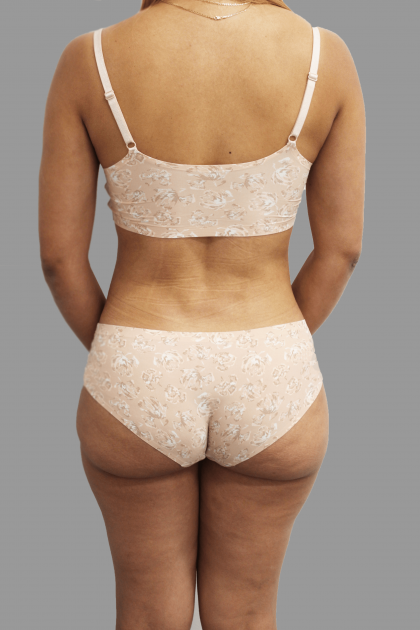 Brazilian Butt Lift Before & After Patient #1459