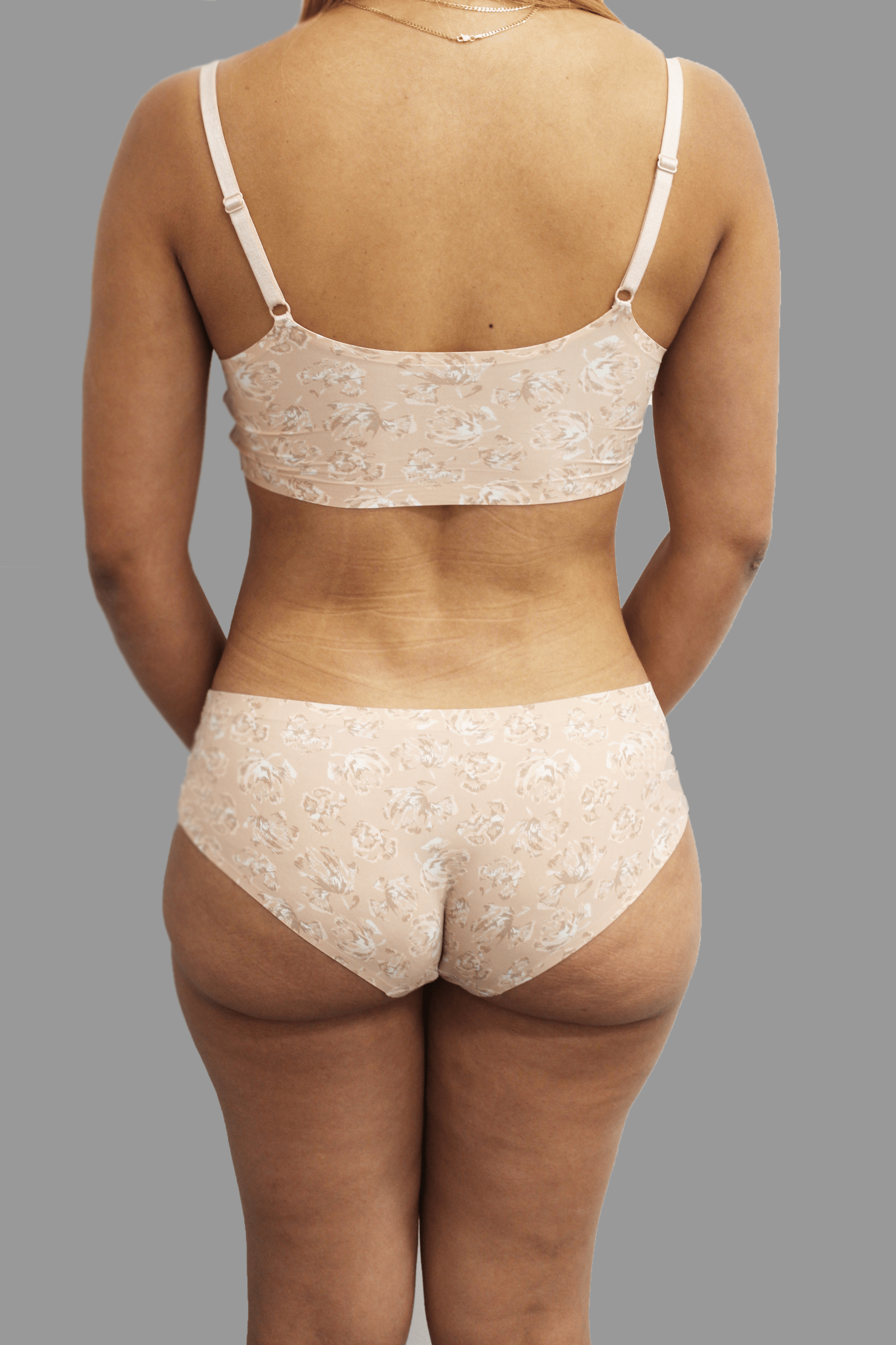 Brazilian Butt Lift Before & After Patient #1459