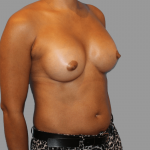 Breast Augmentation Before & After Patient #1462