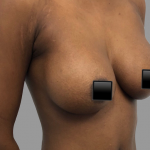 Breast Augmentation Before & After Patient #1470