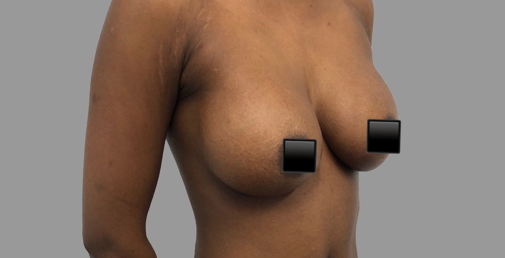 Breast Augmentation Before & After Patient #1470
