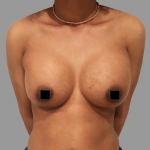 Breast Augmentation Before & After Patient #1473