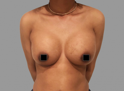 Breast Augmentation Before & After Patient #1473