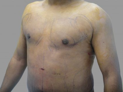 Gynecomastia Before & After Patient #1504