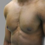 Gynecomastia Before & After Patient #1507