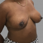Breast Lift Before & After Patient #1479