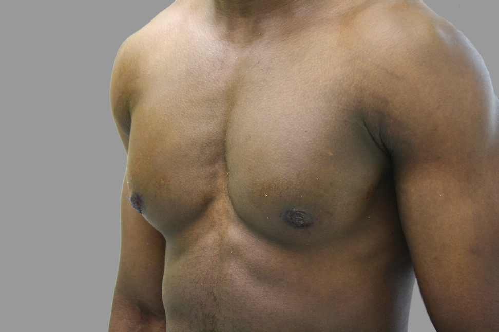Gynecomastia Before & After Patient #1507