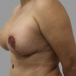 Breast Lift Before & After Patient #1484