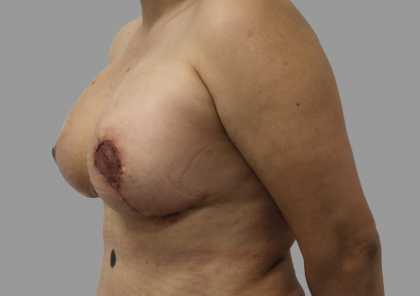 Breast Lift Before & After Patient #1484