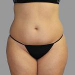 Liposuction Before & After Patient #1526