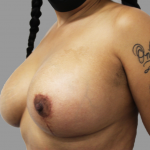 Breast Lift Before & After Patient #1487