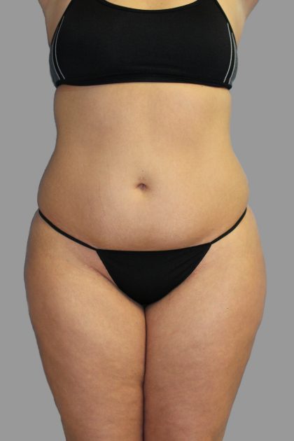 Liposuction Before & After Patient #1526