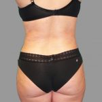 Liposuction Before & After Patient #1529