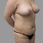 Breast Lift Before & After Patient #1490