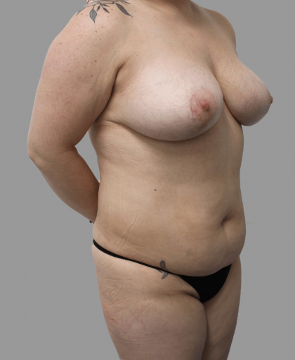 Breast Lift Before & After Patient #1490