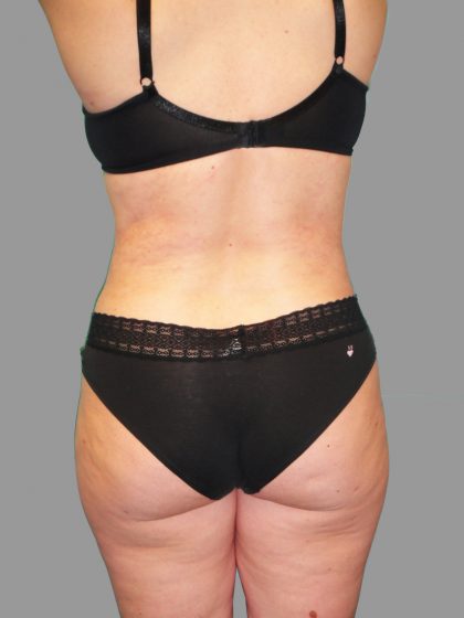 Liposuction Before & After Patient #1529