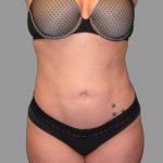 Liposuction Before & After Patient #1529