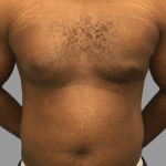 Gynecomastia Before & After Patient #1493
