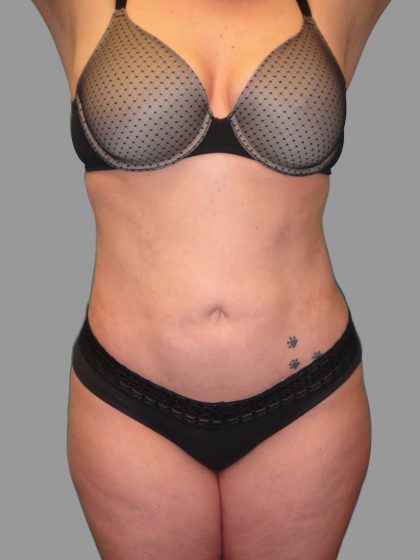 Liposuction Before & After Patient #1529