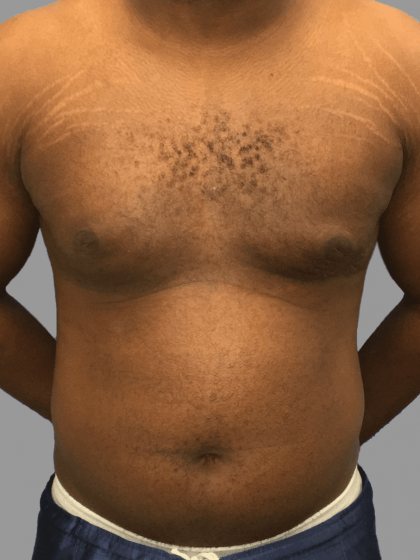 Gynecomastia Before & After Patient #1493