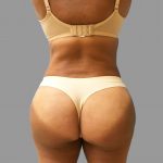 Brazilian Butt Lift Before & After Patient #1426