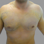 Gynecomastia Before & After Patient #1496