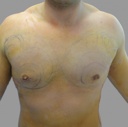 Gynecomastia Before & After Patient #1496