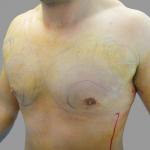 Gynecomastia Before & After Patient #1496