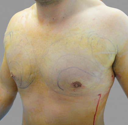 Gynecomastia Before & After Patient #1496