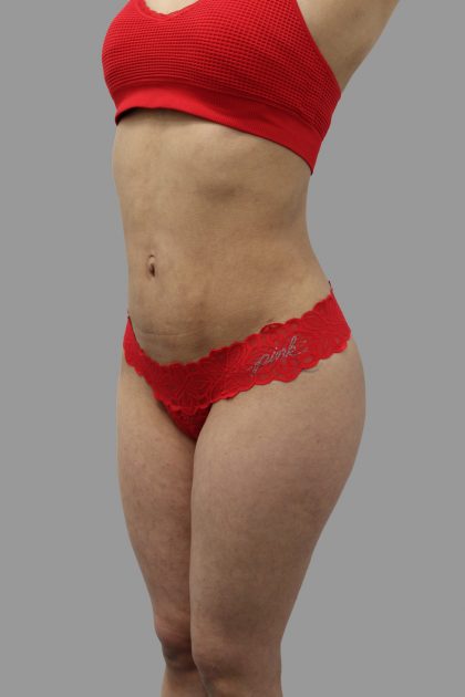 Liposuction Before & After Patient #1548