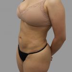 Liposuction Before & After Patient #1553