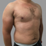 Gynecomastia Before & After Patient #1501