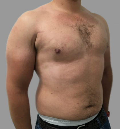 Gynecomastia Before & After Patient #1501