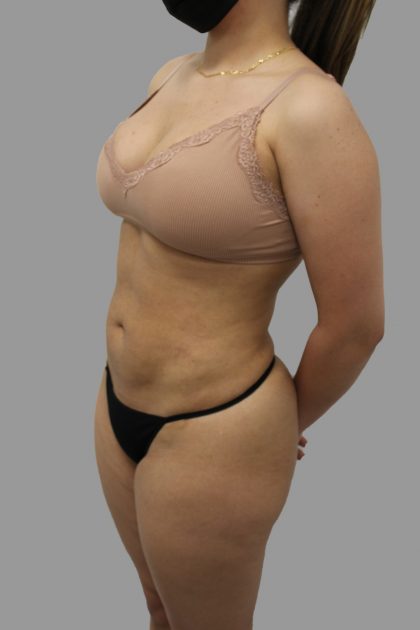 Liposuction Before & After Patient #1553