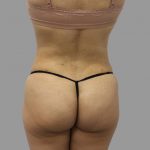 Liposuction Before & After Patient #1553