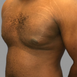 Gynecomastia Before & After Patient #1510