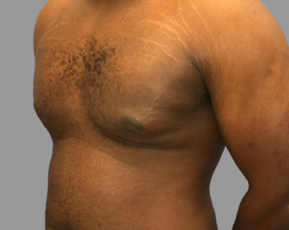 Gynecomastia Before & After Patient #1510