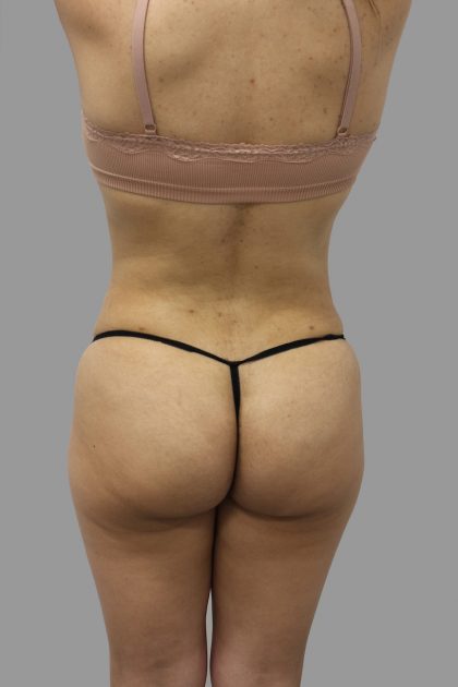 Liposuction Before & After Patient #1553