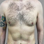 VASER Hi Def Lipo Before & After Patient #1513