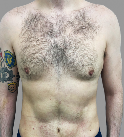 VASER Hi Def Lipo Before & After Patient #1513