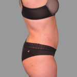 Liposuction Before & After Patient #1529