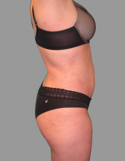 Liposuction Before & After Patient #1529