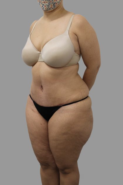 Tummy Tuck Before & After Patient #1582