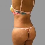 Brazilian Butt Lift Before & After Patient #1426