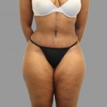 Tummy Tuck Before & After Patient #1608