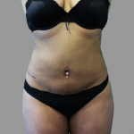 Liposuction Before & After Patient #1539