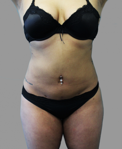 Liposuction Before & After Patient #1539