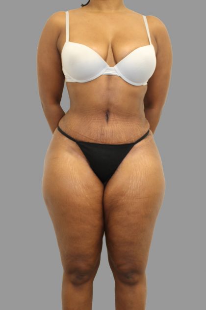 Tummy Tuck Before & After Patient #1608