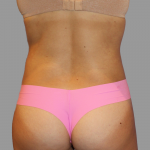 Liposuction Before & After Patient #1542