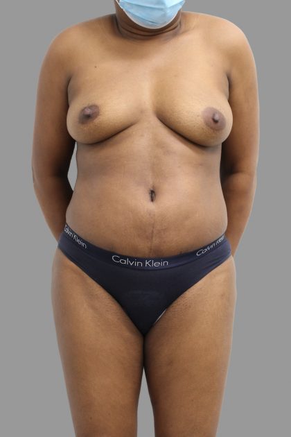 Tummy Tuck Before & After Patient #1613